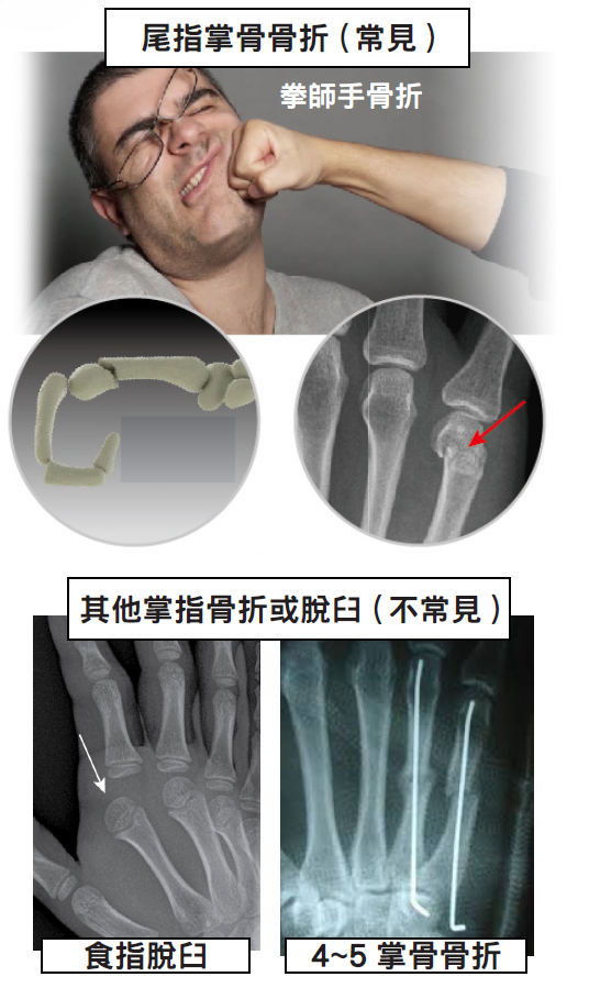 Metacarpal fracture details